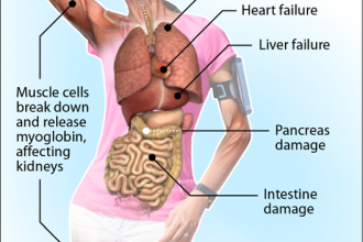 Hyperthermia at a Glance