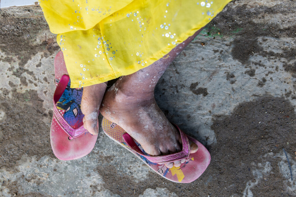 Juni Nadira Patapata, the grandson of Adrian Patapata, suffered from itching all over his body due to polluted water from the Indonesia Weda Industrial Park.