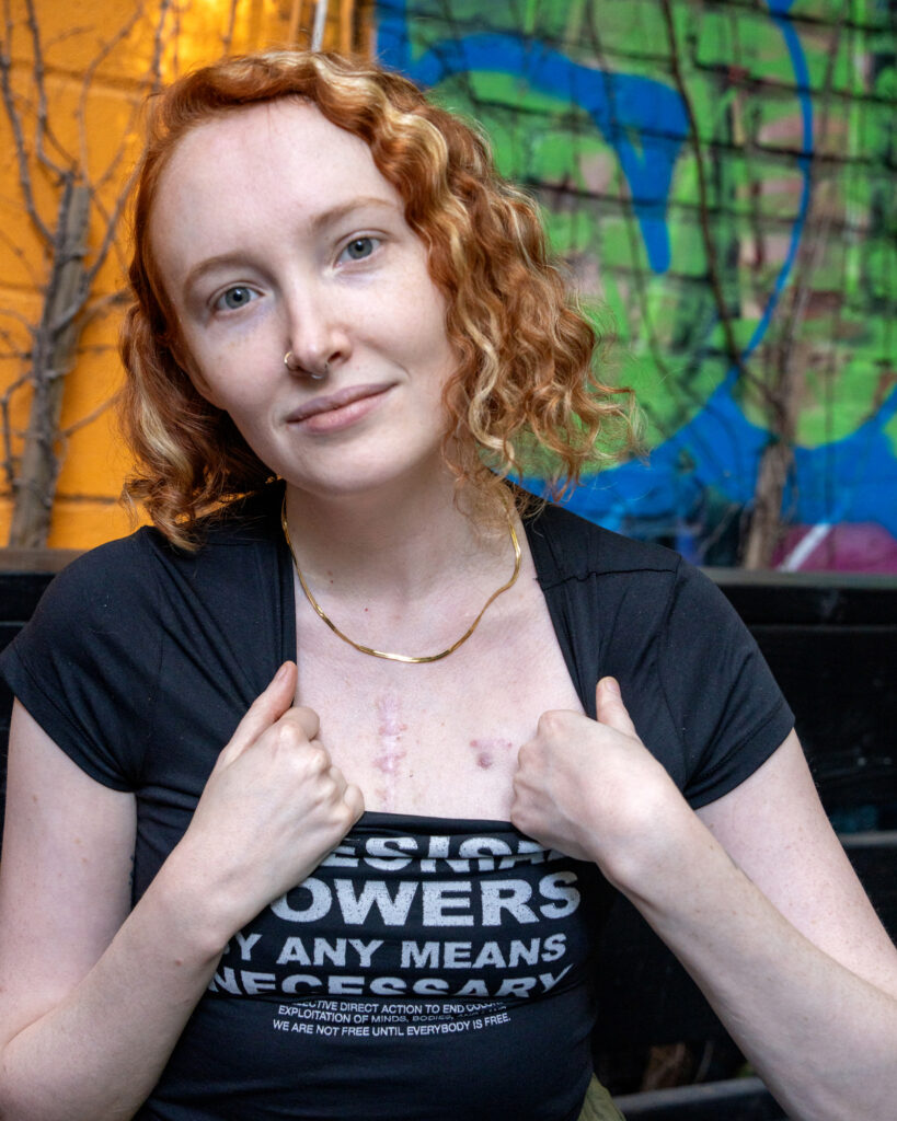 Kate Alexandria displays her sternum scar and port where she receives chemotherapy to suppress her immune system.